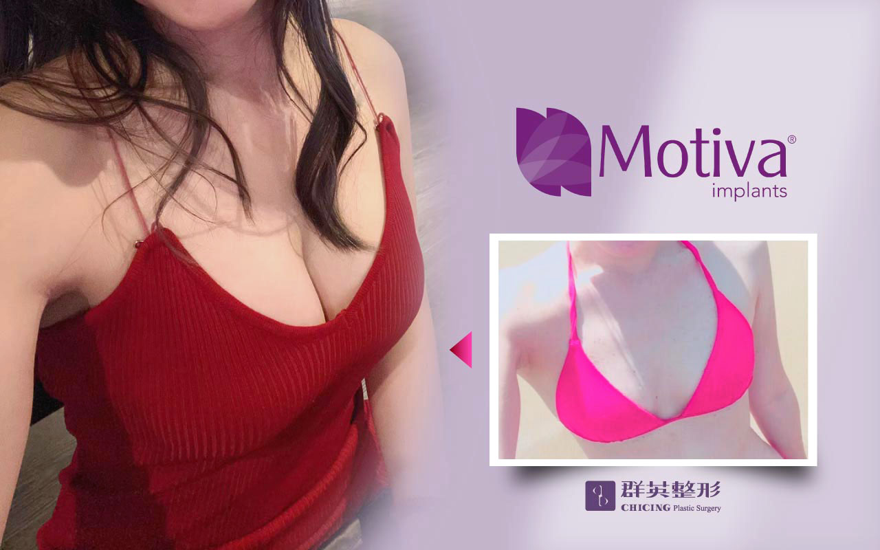 陳大正醫師＿魔滴隆乳＿真實案例＿群英整形外科