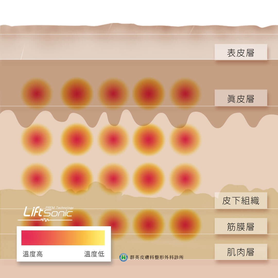 電波音波比較_音波改善皮膚鬆弛