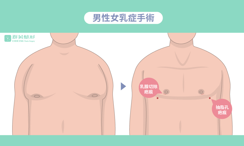 洪章桂醫師_旋轉刀女乳症治療_平胸手術_跨性別手術