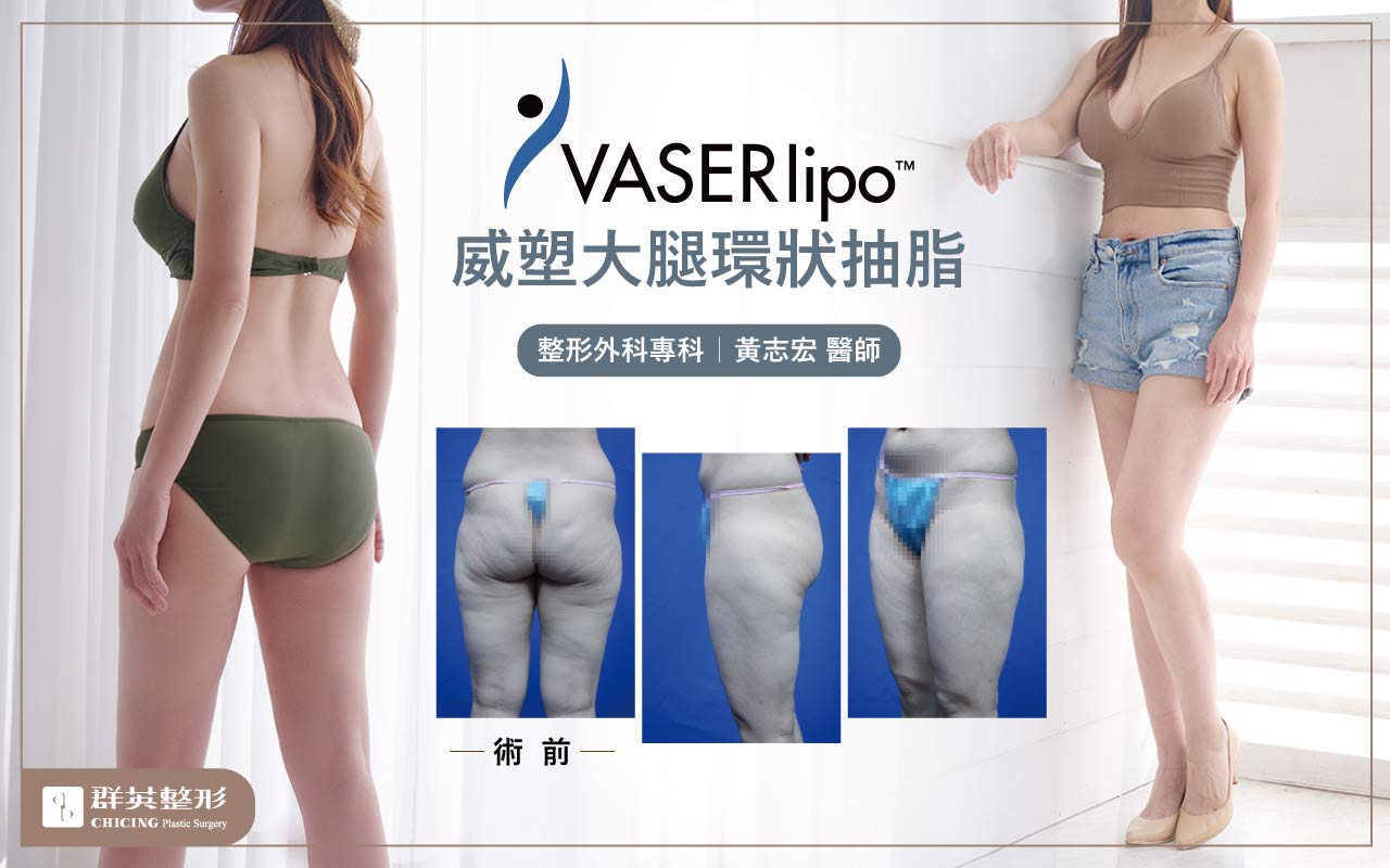 群英黃志宏醫師＿威塑大腿環抽曼陀隆乳術後照05