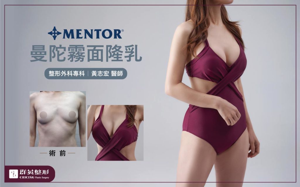 群英黃志宏醫師＿威塑大腿環抽曼陀隆乳術後照06