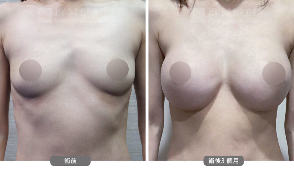 群英黃志宏醫師＿mentor曼陀隆乳術前後比對照100801