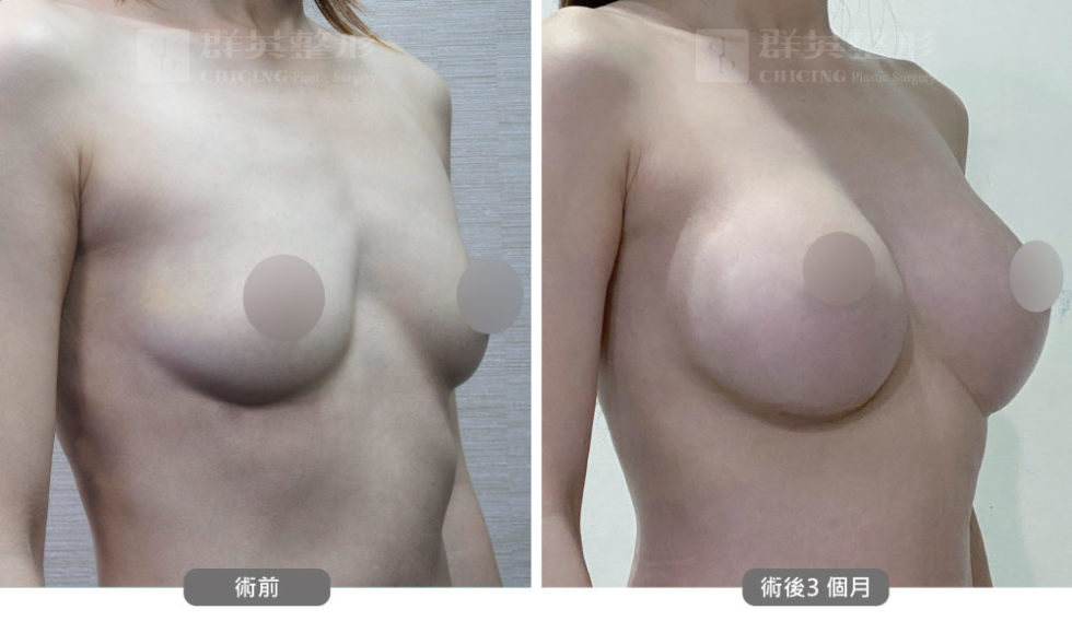 群英黃志宏醫師＿mentor曼陀隆乳術前後比對照100802