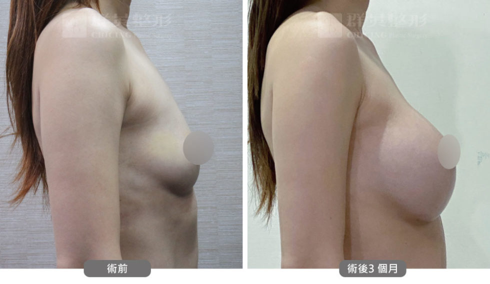 群英黃志宏醫師＿mentor曼陀隆乳術前後比對照100803