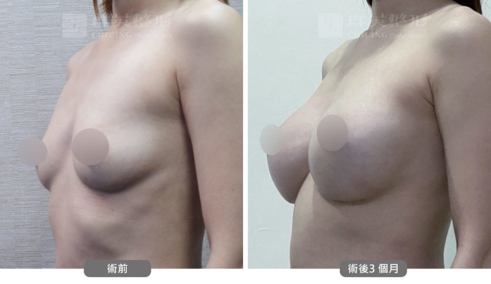 群英黃志宏醫師＿mentor曼陀隆乳術前後比對照100804