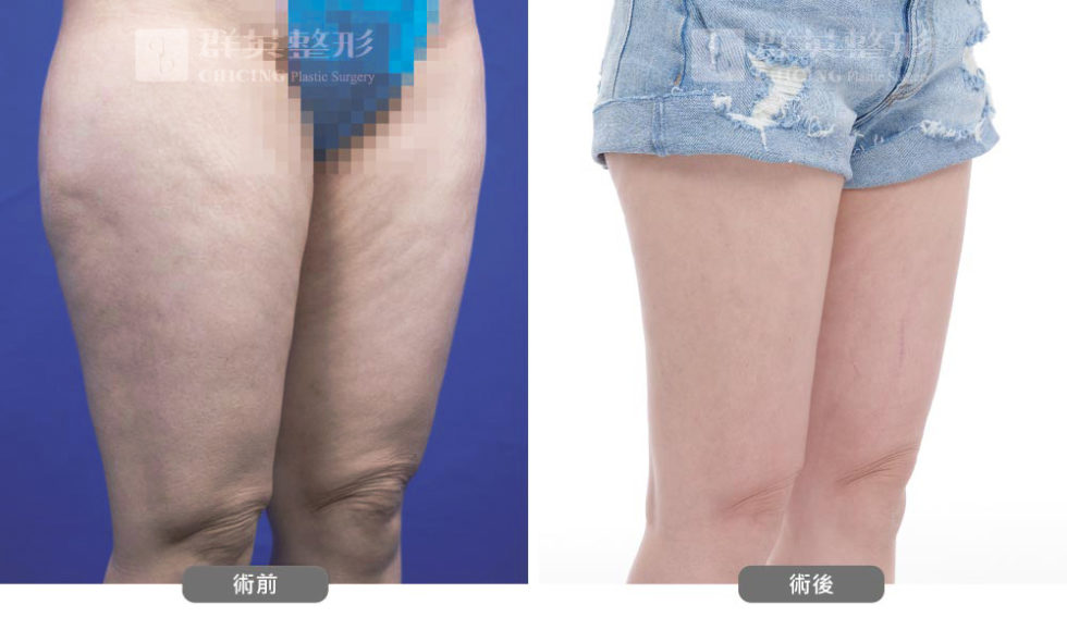群英黃志宏醫師＿VASER威塑大腿術前後比對照100801