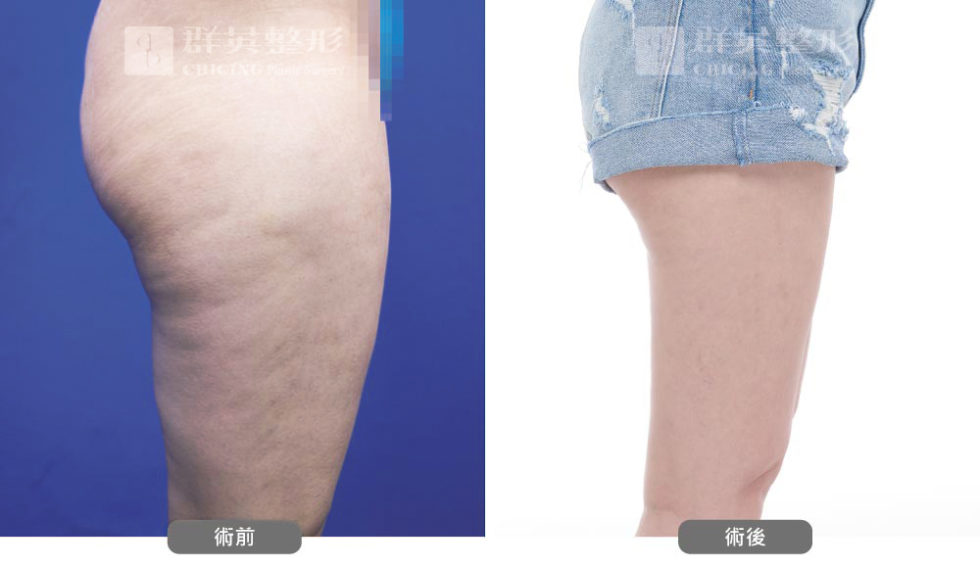 群英黃志宏醫師＿VASER威塑大腿術前後比對照100803