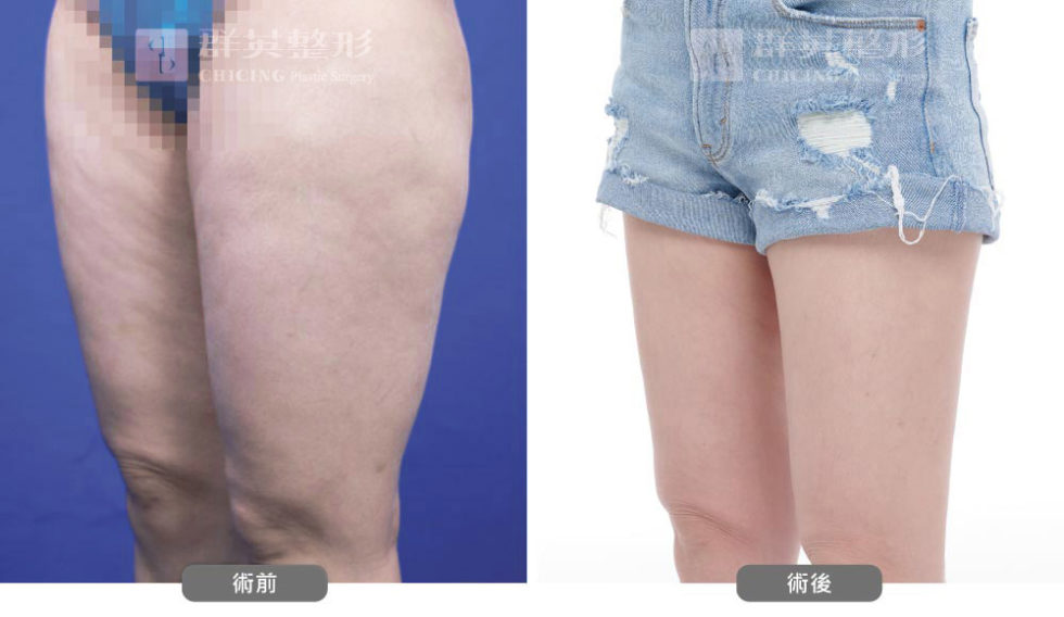 群英黃志宏醫師＿VASER威塑大腿術前後比對照100804