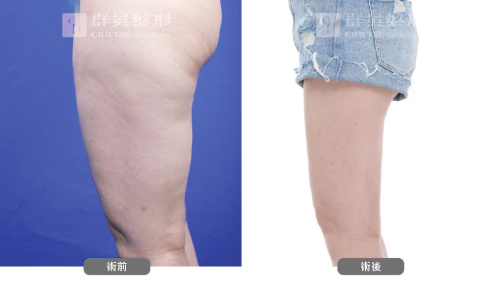 群英黃志宏醫師＿VASER威塑大腿術前後比對照100805