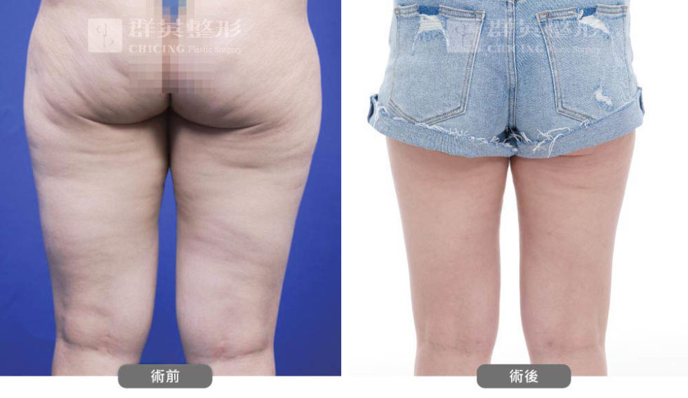群英黃志宏醫師＿VASER威塑大腿術前後比對照100806