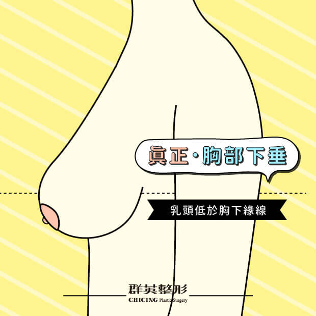 高雄_內視鏡隆乳_推薦_姚勝發醫師,真正胸部下垂_減肥胸部下垂