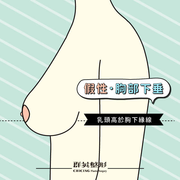 高雄_內視鏡隆乳_推薦_姚勝發醫師,假性胸部下垂