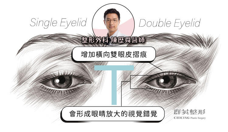 陳歷舜醫師_提眼瞼肌手術_雙眼皮手術