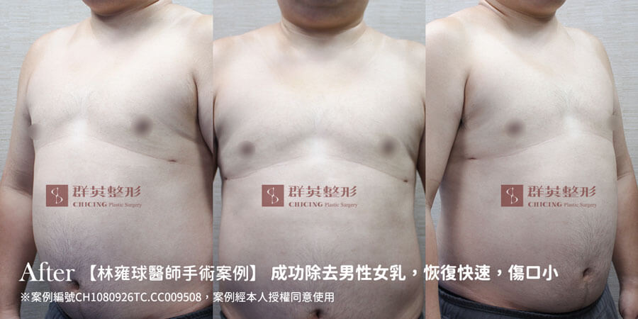台中女乳症手術_推薦林雍球醫師_女乳症案例