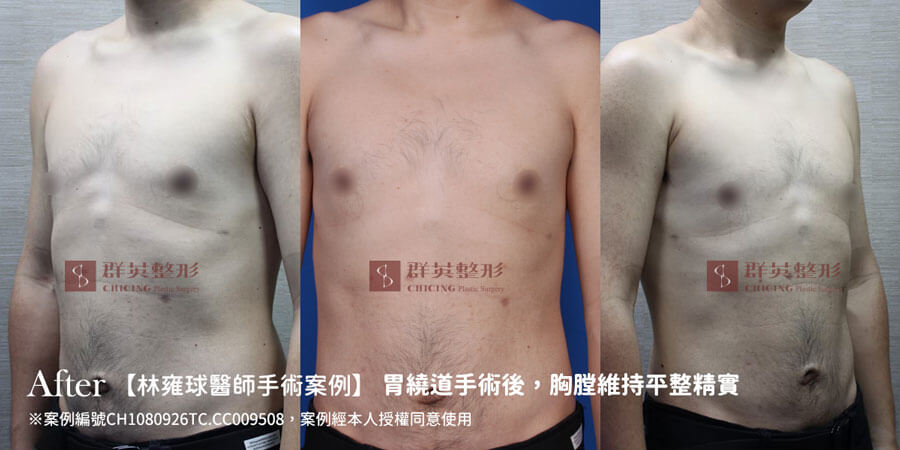 台中女乳症手術_推薦林雍球醫師_女乳症案例(1)