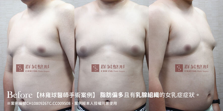 台中女乳症手術_推薦林雍球醫師_女乳症案例