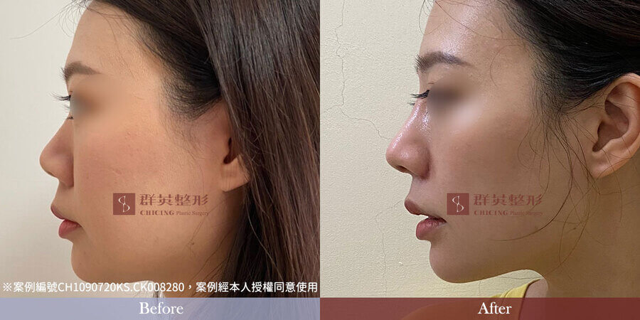 群英整形_隆鼻案例_台中隆鼻_台北隆鼻_高雄窿鼻