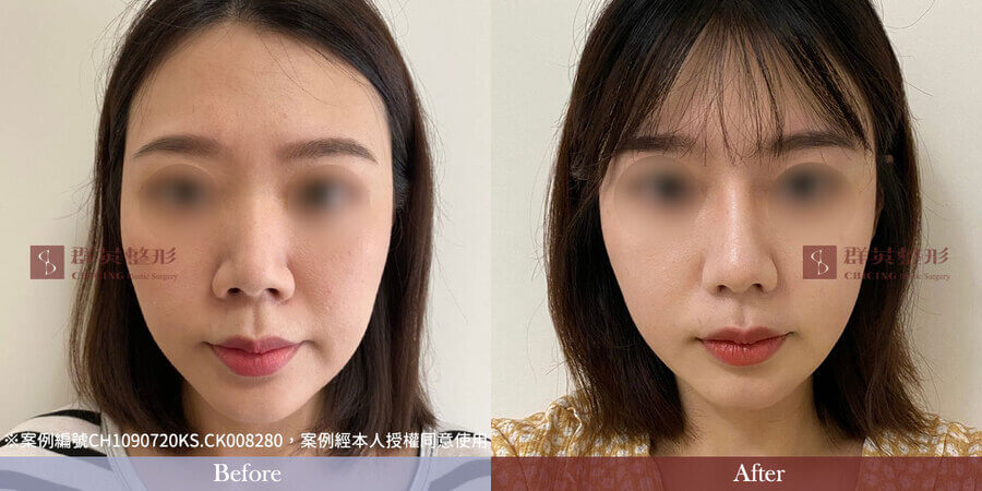 群英整形_隆鼻案例_台中隆鼻_台北隆鼻_高雄窿鼻