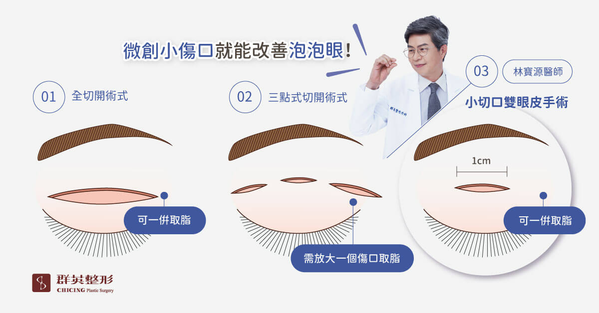 小切口雙眼皮手術_林寶源醫師_高雄群英