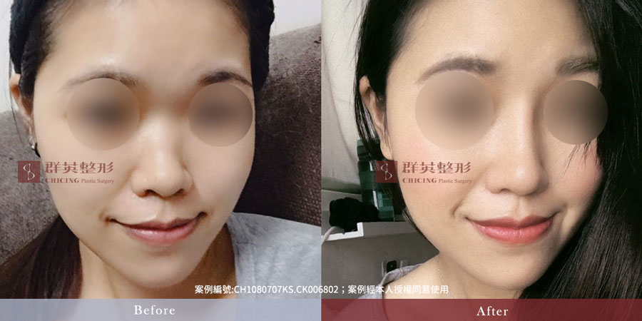 群英 隆鼻價格費用_蒜頭鼻_台北隆鼻、台中隆鼻、高雄隆鼻