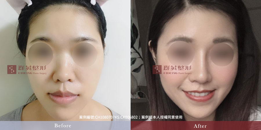 群英 隆鼻價格費用_蒜頭鼻_台北隆鼻、台中隆鼻、高雄隆鼻