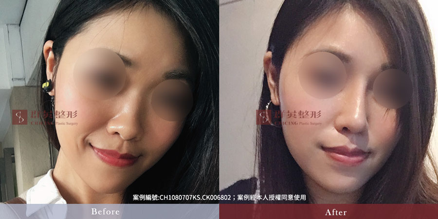 群英 隆鼻價格費用_蒜頭鼻_台北隆鼻、台中隆鼻、高雄隆鼻