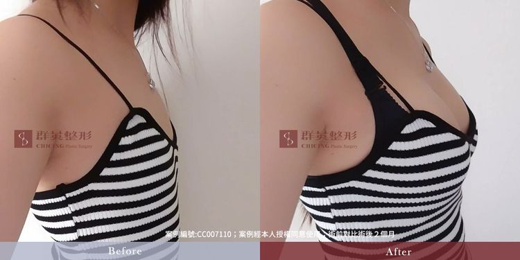 台中隆乳_隆乳手術_隆乳案例_推薦醫美診所_林雍球醫師