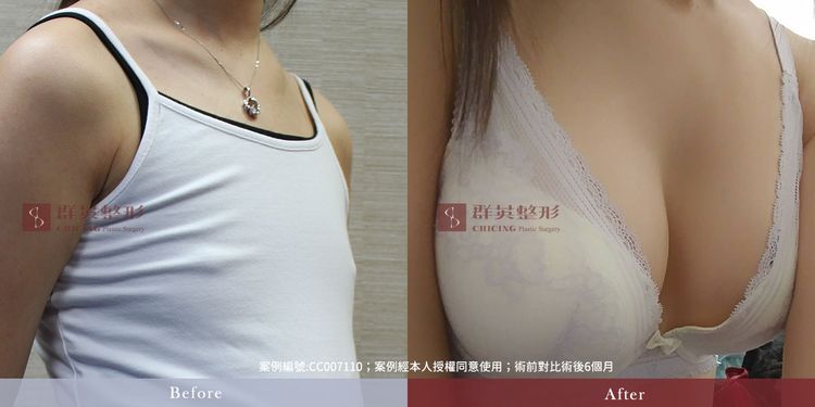 台中隆乳_隆乳手術_隆乳案例_推薦醫美診所_林雍球醫師