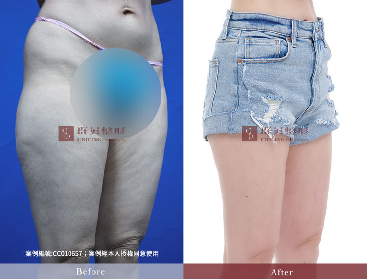 抽脂案例_台中抽脂醫生推薦黃志宏_台中威塑抽脂推薦_馬鞍肉