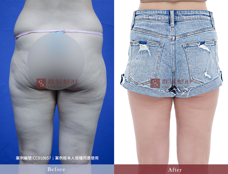 馬鞍肉抽脂_台中威塑抽脂推薦_馬鞍肉_假胯寬_黃志宏醫師