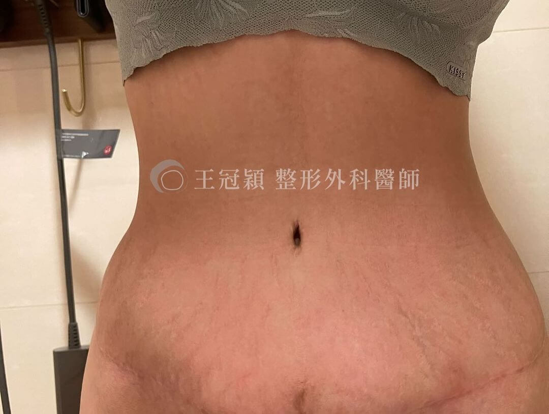 台中腹部拉皮手術推薦_腹直肌縫合