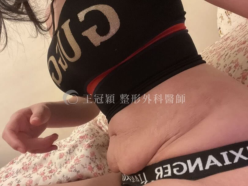 台中腹部拉皮手術推薦_腹直肌縫合