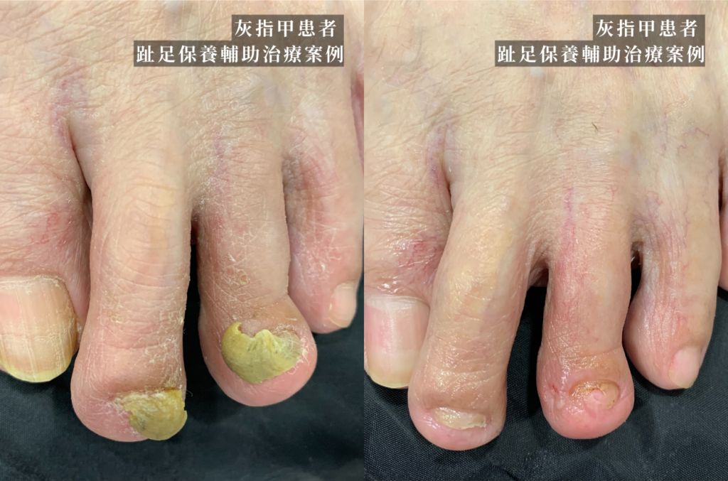 新北_永和_皮膚科_灰指甲_指甲病症_皮膚_足部_甲癬_案例01