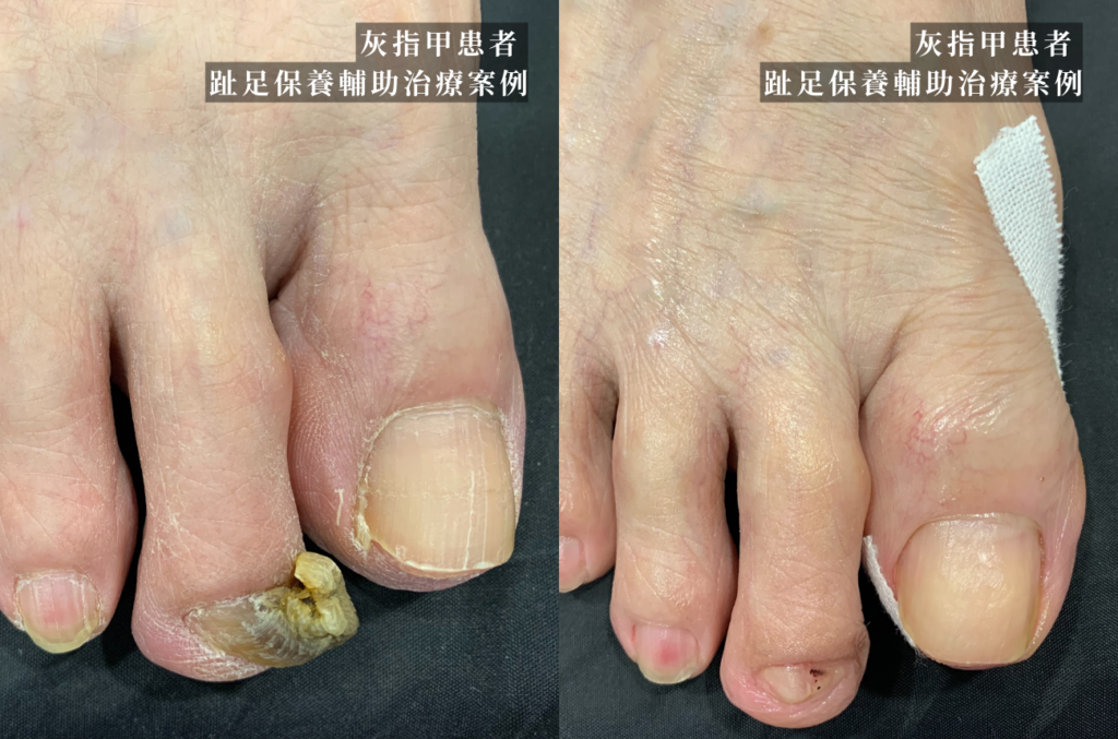 新北_永和_皮膚科_灰指甲_指甲病症_皮膚_足部_甲癬_案例02