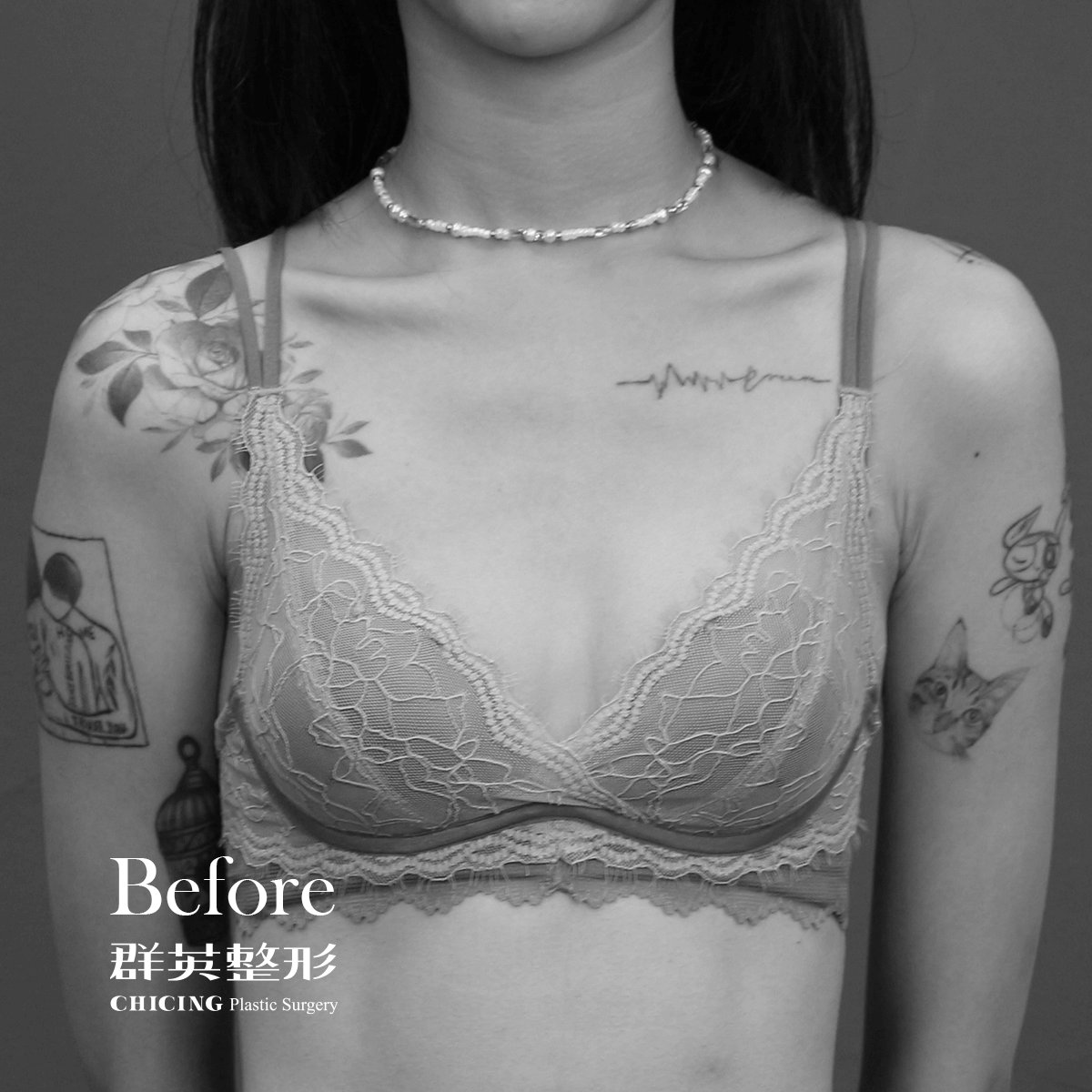 台中魔滴隆乳推薦找群英整形外科
