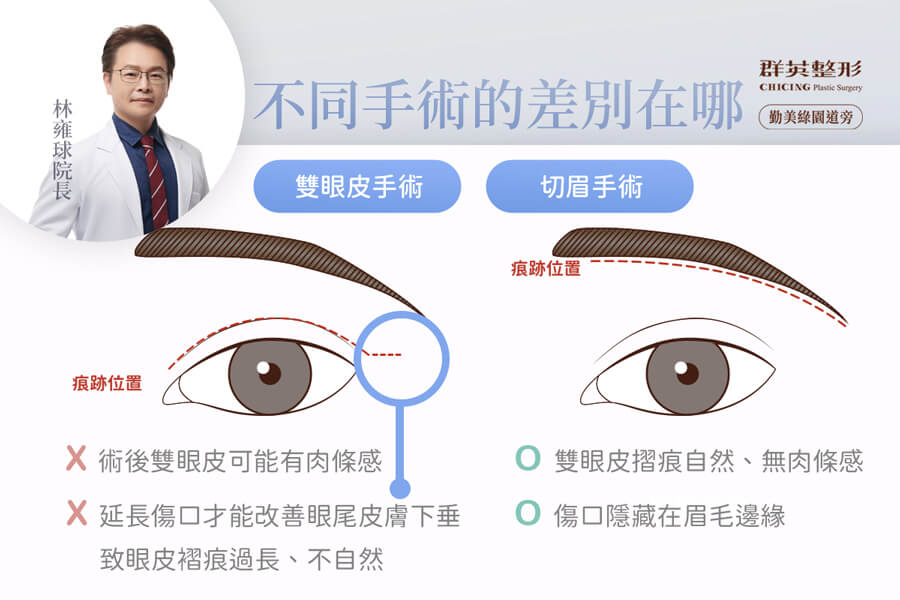 雙眼皮手術與切眉手術的差別_台中拉皮推薦台中群英林雍球醫師