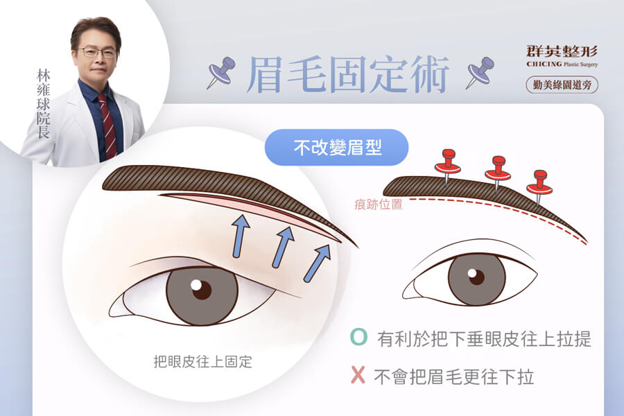 切眉 手術 或 眉下切 手術 改善 眼皮下垂_推薦台中群英林雍球醫師
