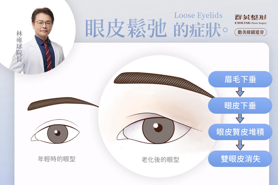 眼皮下垂的症狀_台中拉皮推薦群英林雍球醫師