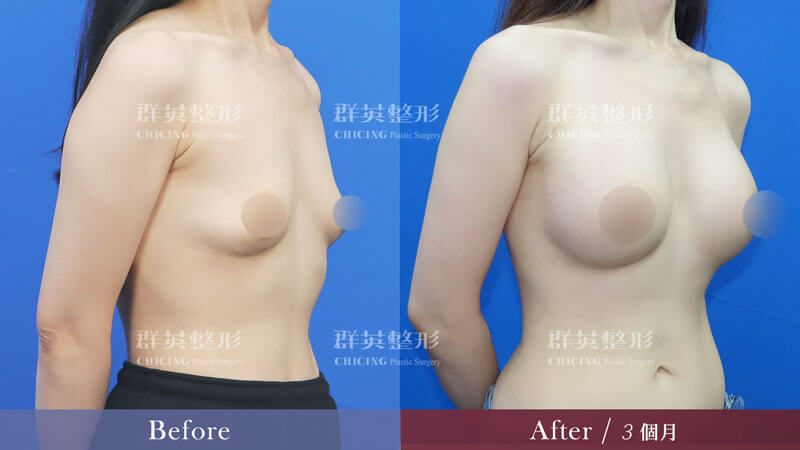 柔滴隆乳_台中群英整形_陳大正醫師_產後胸部萎縮下垂