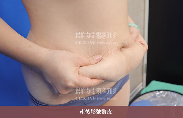 產後肚皮鬆弛與妊娠紋_台中群英整形外科腹部整形案例