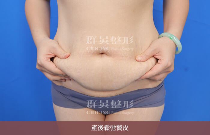 產後肚皮鬆弛與妊娠紋_台中群英整形外科腹部整形案例