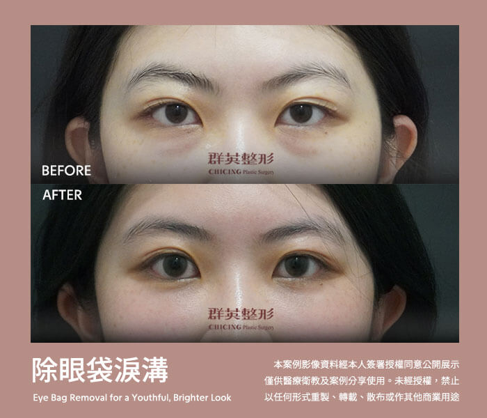 群英 眼袋手術 案例