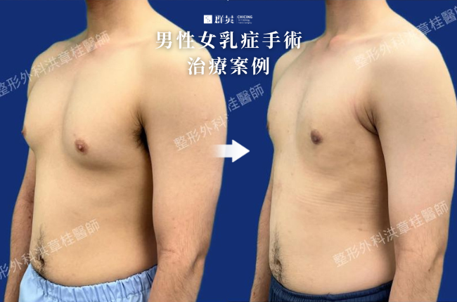 1_群英_洪章桂醫師-男性女乳症手術案例