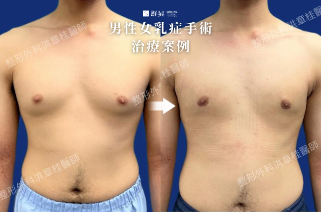 2_群英_洪章桂醫師-男性女乳症手術案例