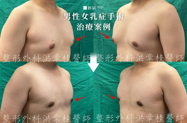 5_群英_洪章桂醫師-男性女乳症手術案例