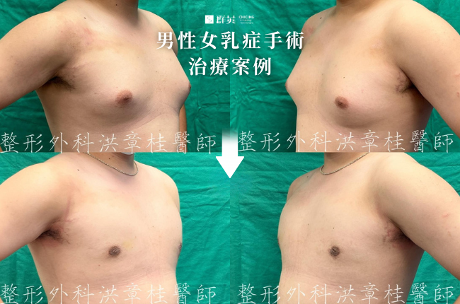 6_群英_洪章桂醫師-男性女乳症手術案例