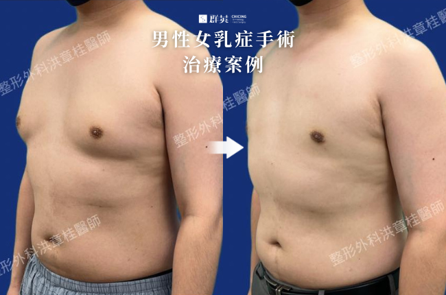 8_群英_洪章桂醫師-男性女乳症手術案例