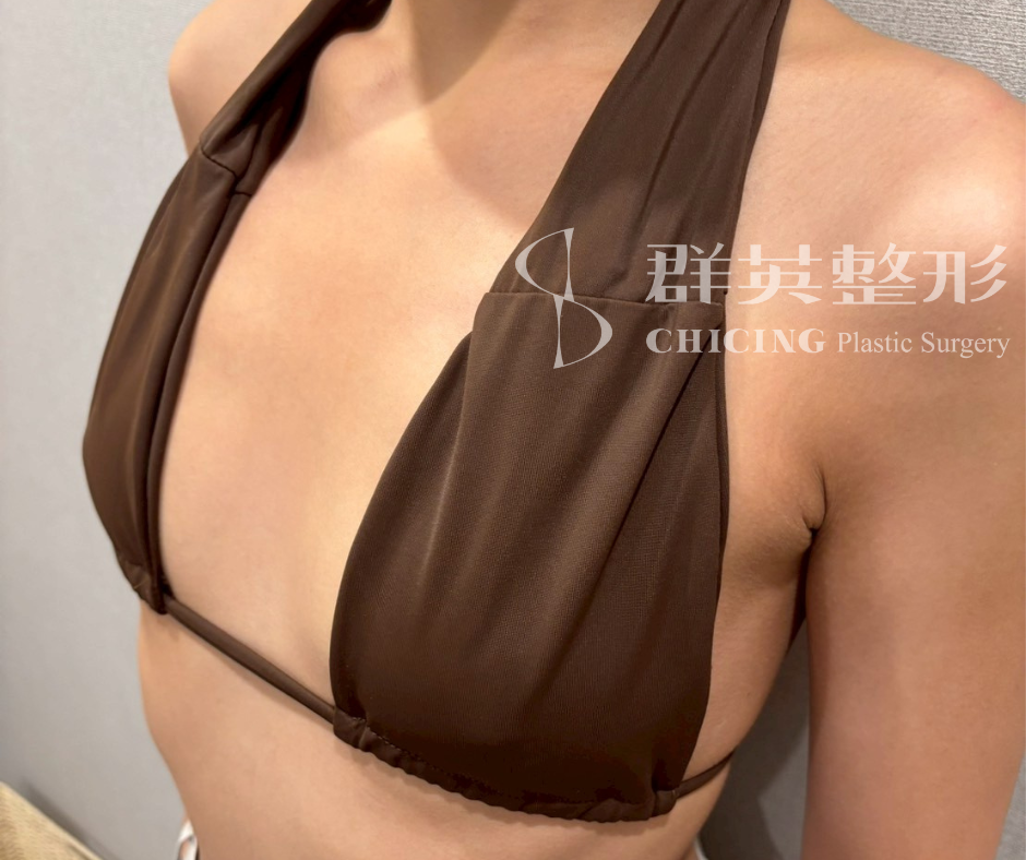 隆乳案例_術前_比基尼