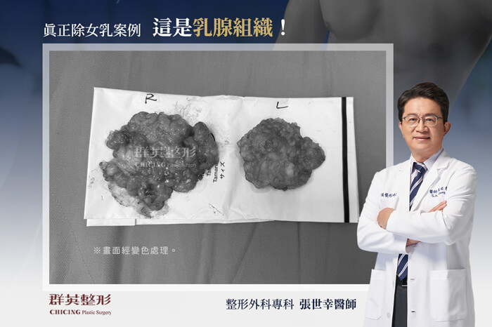 台中男性女乳症案例＿群英整形外科＿張世幸醫師