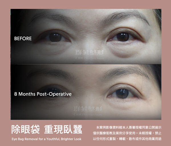 台中群英 老化型眼袋 眼袋外開 填補淚溝 最新案例